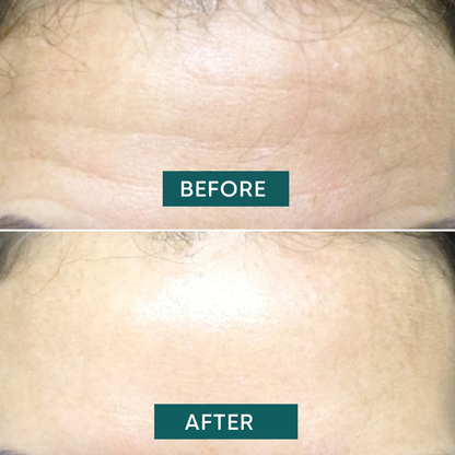 Plasturi Antirid pentru Frunte cu Acid Hialuronic